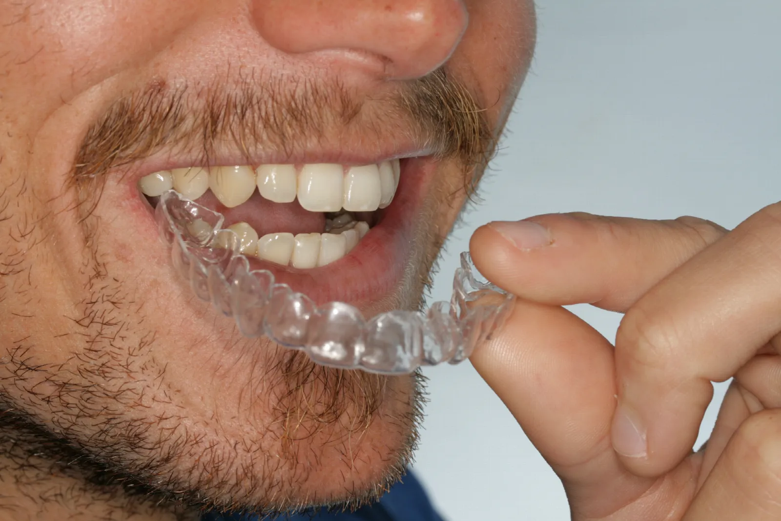 Primer plano de la boca de un adulto sonriendo con un alineador transparente sobre los dientes de abajo