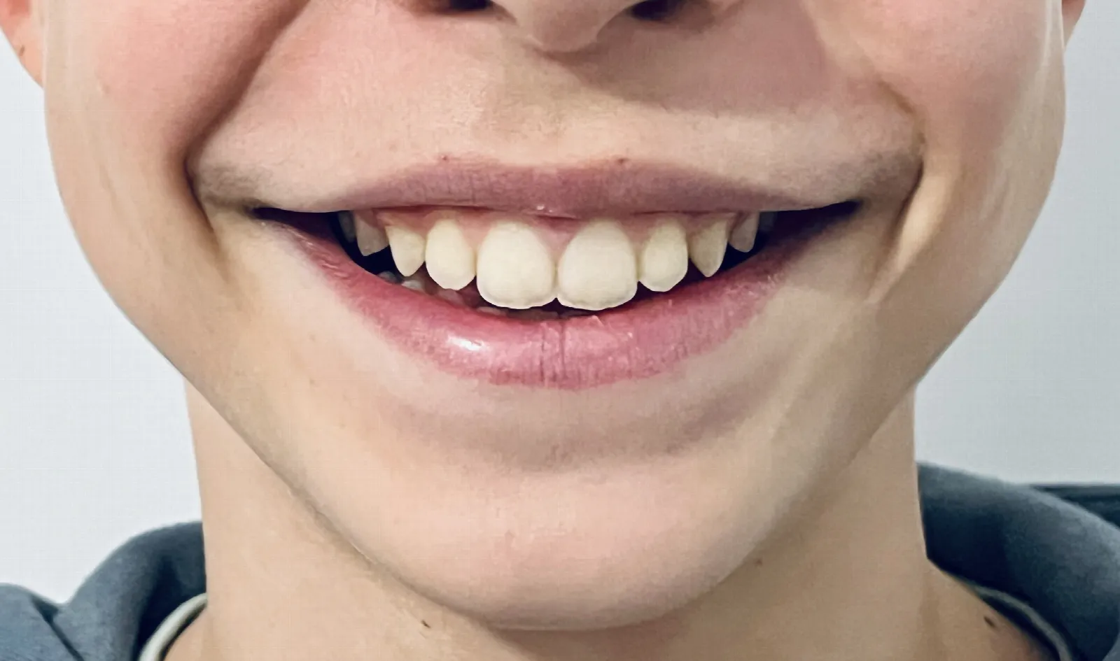 Primer plano de la sonrisa de una persona joven, con los dientes delanteros algo desalineados